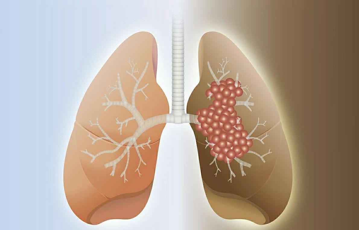 郑州治肺癌的中医