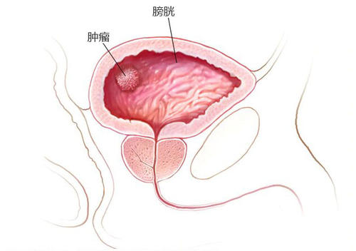 膀胱癌的危险因素,郑州中医师治疗膀胱癌