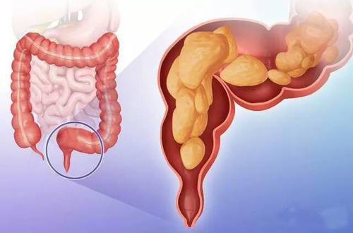 直肠癌给人体带来怎样的危害
